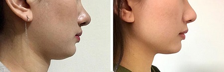 more&rarr; 鬆垮雙下巴緊緻改善