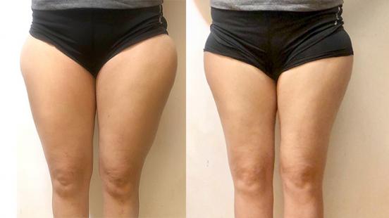 空氣微雕瘦大腿 酪梨之友