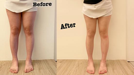 中醫減重 大腿埋線