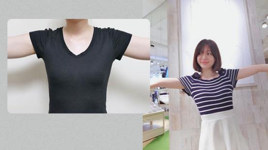 老字號人生中醫診所 空氣微雕兩週記錄分享 再見了蝴蝶袖!